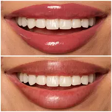 Labios de modelo usando Lip I.V. 08 Drippin' in Rose.