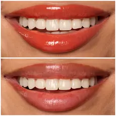 Labios de modelo usando Lip I.V. 12 Burst That Tang.